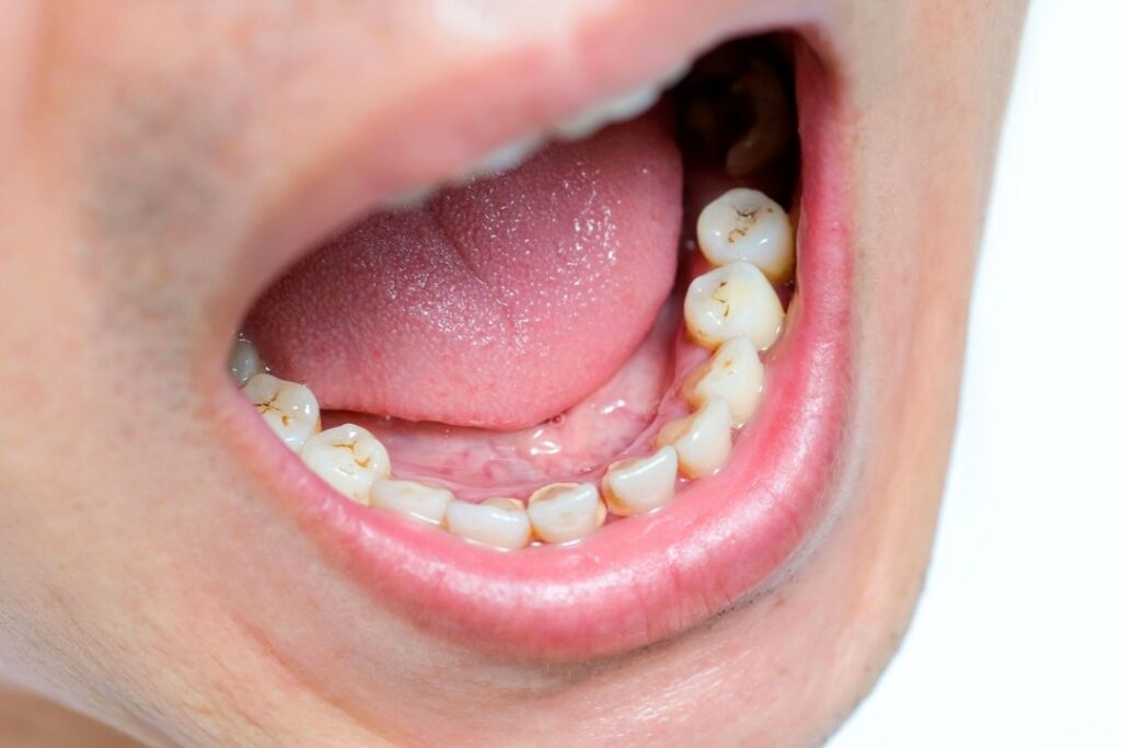Do czego prowadzi zaniedbanie higieny jamy ustnej?